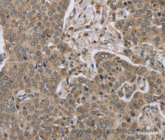 Immunohistochemistry of paraffin-embedded Human liver cancer tissue using IL15RA Polyclonal Antibody at dilution 1:45