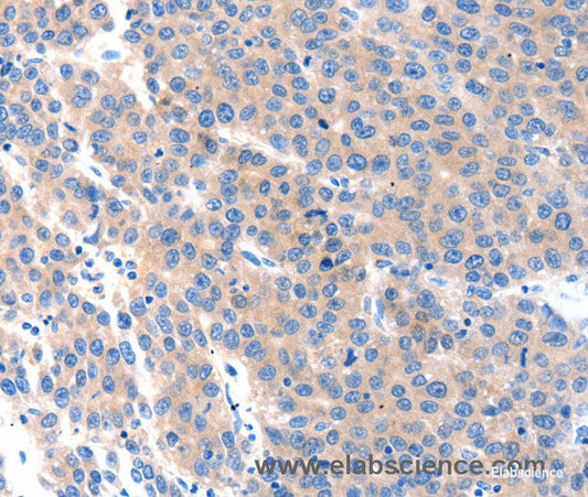 Immunohistochemistry of paraffin-embedded Human liver cancer tissue using KLK2 Polyclonal Antibody at dilution 1:100