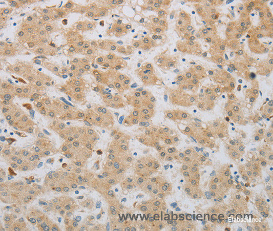 Immunohistochemistry of paraffin-embedded Human liver cancer tissue using NBN Polyclonal Antibody at dilution 1:50