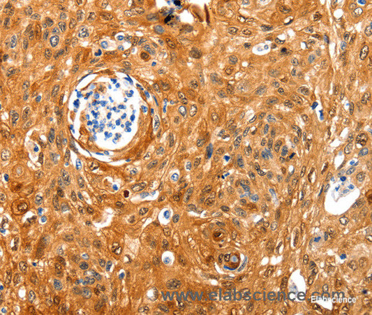 Immunohistochemistry of paraffin-embedded Human cervical cancer tissue using NCOR1 Polyclonal Antibody at dilution 1:100