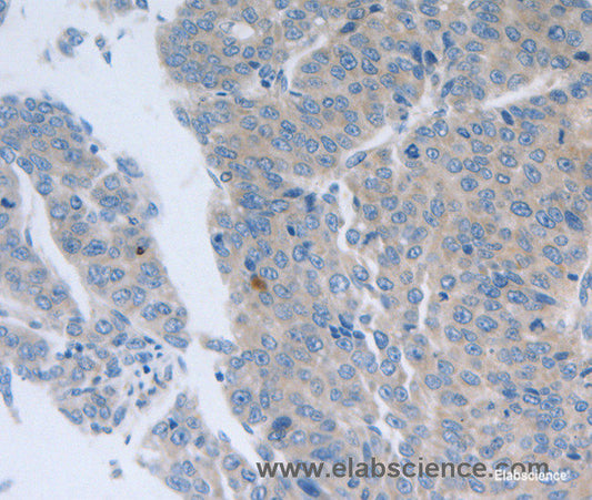 Immunohistochemistry of paraffin-embedded Human liver cancer tissue using GRIN1 Polyclonal Antibody at dilution 1:50