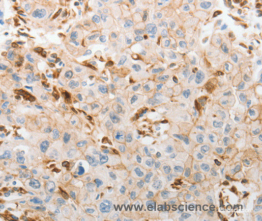 Immunohistochemistry of paraffin-embedded Human lung cancer tissue using SLC15A2 Polyclonal Antibody at dilution 1:60