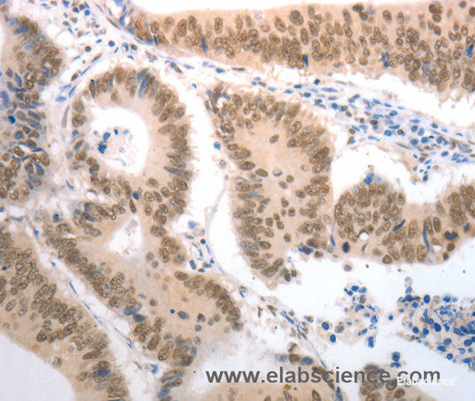 Immunohistochemistry of paraffin-embedded Human colon cancer tissue using RAD52 Polyclonal Antibody at dilution 1:50