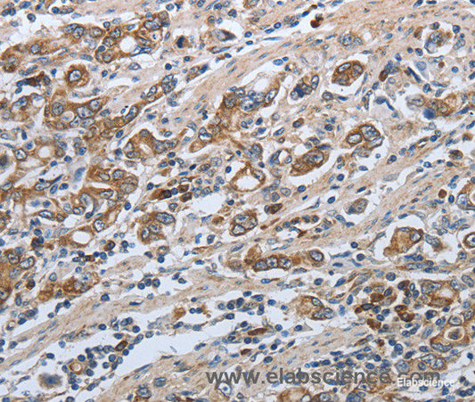 Immunohistochemistry of paraffin-embedded Human gasrtic cancer tissue using SLC34A2 Polyclonal Antibody at dilution of 1:50