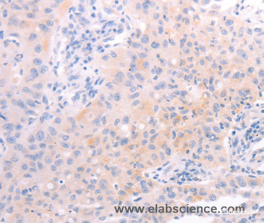 Immunohistochemistry of paraffin-embedded Human lung cancer tissue using AMH Polyclonal Antibody at dilution 1:30