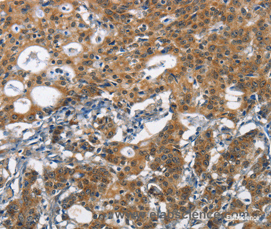 Immunohistochemistry of paraffin-embedded Human gasrtic cancer tissue using DCC Polyclonal Antibody at dilution 1:70
