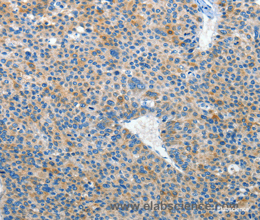 Immunohistochemistry of paraffin-embedded Human liver cancer tissue using EPHB3 Polyclonal Antibody at dilution 1:50