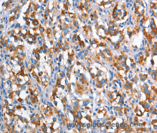 Immunohistochemistry of paraffin-embedded Human thyroid cancer tissue using CD226 Polyclonal Antibody at dilution 1:60