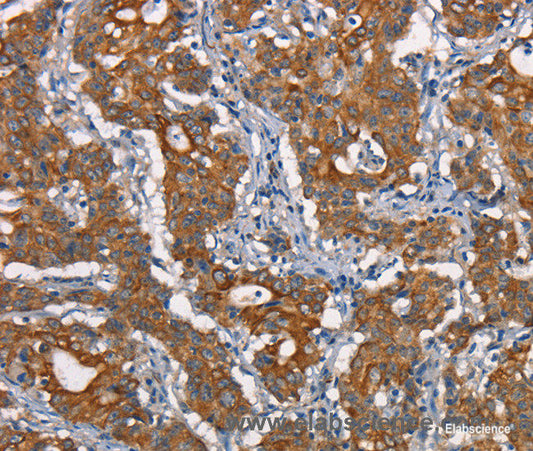 Immunohistochemistry of paraffin-embedded Human gasrtic cancer tissue using CDC23 Polyclonal Antibody at dilution 1:50