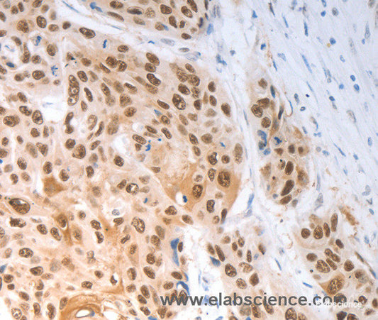 Immunohistochemistry of paraffin-embedded Human ovarian cancer tissue using SLC22A8 Polyclonal Antibody at dilution 1:70