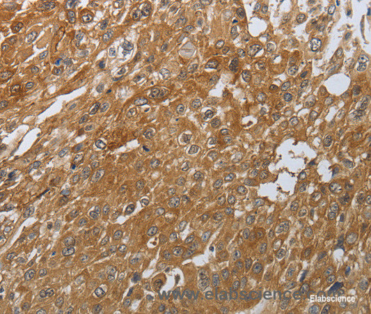 Immunohistochemistry of paraffin-embedded Human esophagus cancer tissue using PTPRM Polyclonal Antibody at dilution 1:80