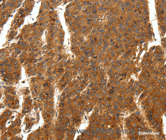 Immunohistochemistry of paraffin-embedded Human breast cancer tissue using SCN11A Polyclonal Antibody at dilution 1:50