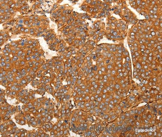 Immunohistochemistry of paraffin-embedded Human liver cancer tissue using SFRP1 Polyclonal Antibody at dilution 1:80