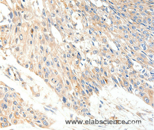 Immunohistochemistry of paraffin-embedded Human esophagus cancer tissue using SLC27A1 Polyclonal Antibody at dilution 1:40