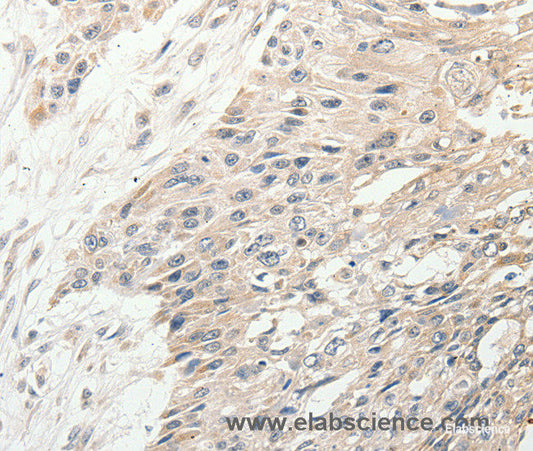 Immunohistochemistry of paraffin-embedded Human esophagus cancer tissue using SLC9A7 Polyclonal Antibody at dilution 1:50