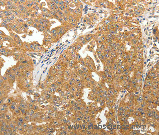 Immunohistochemistry of paraffin-embedded Human ovarian cancer tissue using MAP1B  Polyclonal Antibody at dilution 1:40