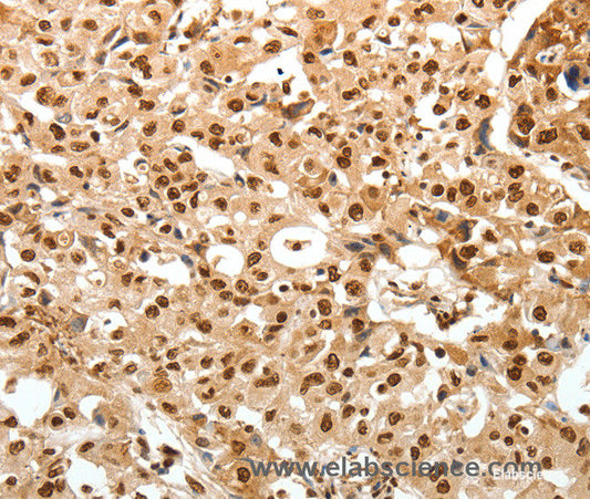Immunohistochemistry of paraffin-embedded Human ovarian cancer tissue using TNXB Polyclonal Antibody at dilution 1:30