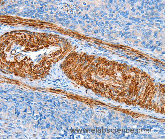 Immunohistochemistry of paraffin-embedded Human cervical cancer tissue using AARS Polyclonal Antibody at dilution 1:60