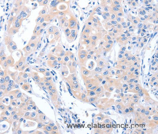 Immunohistochemistry of paraffin-embedded Human lung cancer tissue using ARHGEF6 Polyclonal Antibody at dilution 1:70