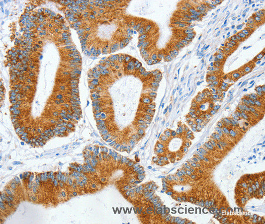 Immunohistochemistry of paraffin-embedded Human colon cancer tissue using MANF Polyclonal Antibody at dilution 1:50