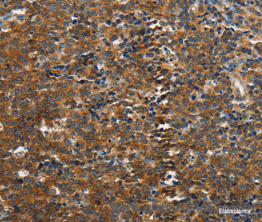 Immunohistochemistry of paraffin-embedded Human lymphoma tissue using PIK3R4 Polyclonal Antibody at dilution 1:85