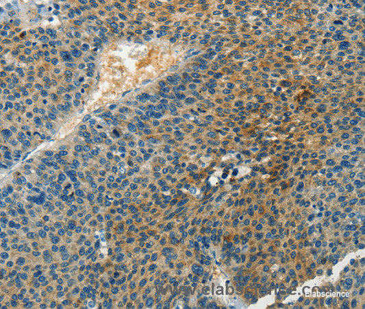 Immunohistochemistry of paraffin-embedded Human liver cancer tissue using DGK beta Polyclonal Antibody at dilution 1:60