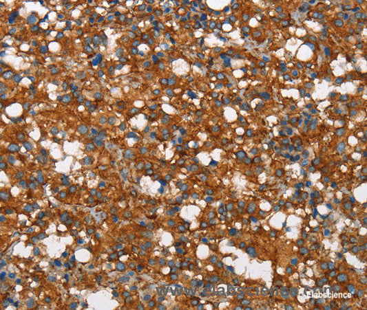 Immunohistochemistry of paraffin-embedded Human thyroid cancer tissue using COX5A Polyclonal Antibody at dilution 1:40