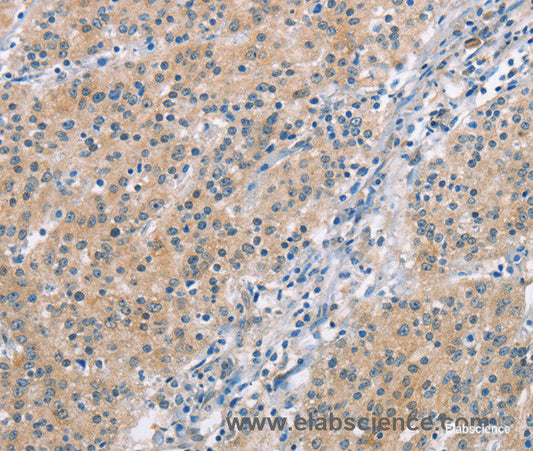 Immunohistochemistry of paraffin-embedded Human gasrtic cancer tissue using MCL1 Polyclonal Antibody at dilution 1:60