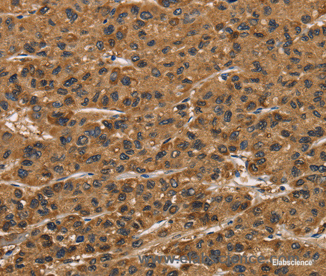 Immunohistochemistry of paraffin-embedded Human liver cancer tissue using ATP7A  Polyclonal Antibody at dilution 1:50