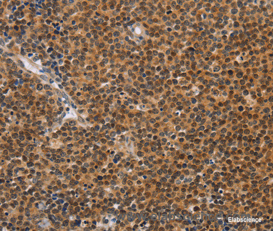 Immunohistochemistry of paraffin-embedded Human Lymphoma tissue using CD36 Polyclonal Antibody at dilution 1:60