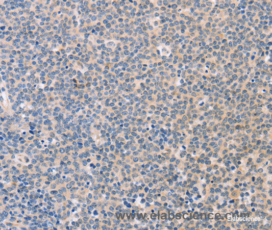 Immunohistochemistry of paraffin-embedded Human Lymphoma tissue using CD56 Polyclonal Antibody at dilution 1:30