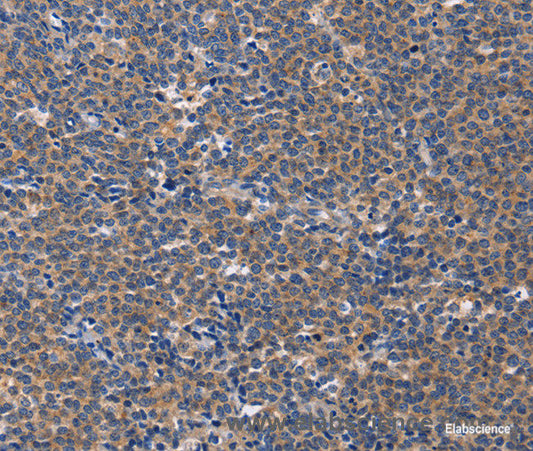 Immunohistochemistry of paraffin-embedded Human Lymphoma tissue using CD5L Polyclonal Antibody at dilution 1:40