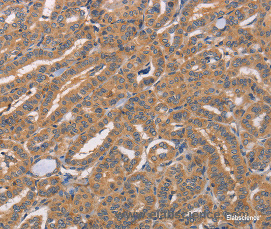 Immunohistochemistry of paraffin-embedded Human thyroid cancer tissue using CDCA4 Polyclonal Antibody at dilution 1:50