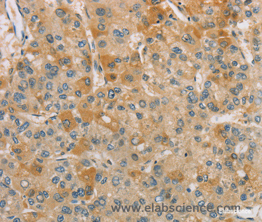 Immunohistochemistry of paraffin-embedded Human liver cancer tissue using CENPF Polyclonal Antibody at dilution 1:40
