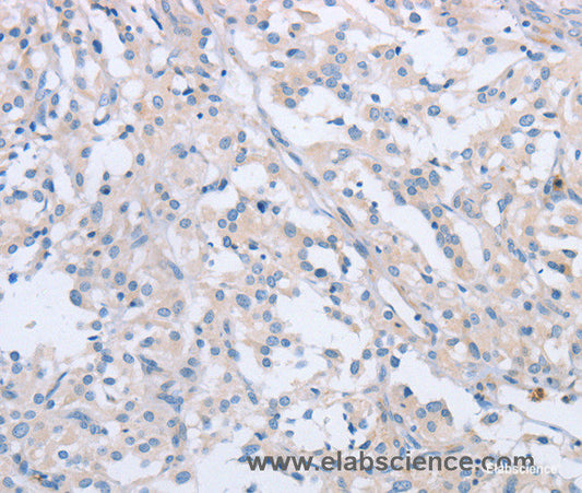 Immunohistochemistry of paraffin-embedded Human thyroid cancer tissue using AGAP2 Polyclonal Antibody at dilution 1:60