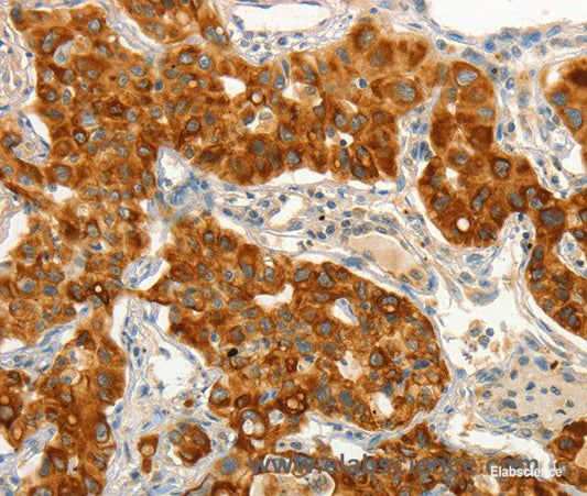 Immunohistochemistry of paraffin-embedded Human lung cancer tissue using CIB1 Polyclonal Antibody at dilution 1:50