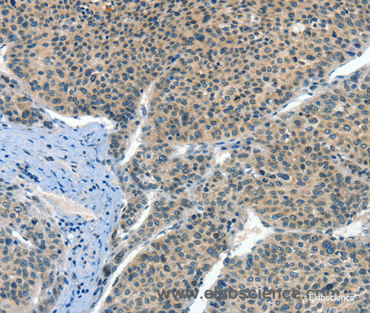 Immunohistochemistry of paraffin-embedded Human liver cancer tissue using CRLF2 Polyclonal Antibody at dilution 1:60
