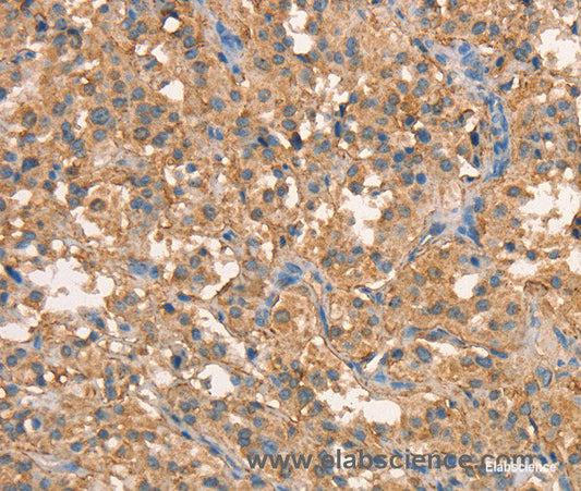 Immunohistochemistry of paraffin-embedded Human thyroid cancer tissue using CRELD1 Polyclonal Antibody at dilution 1:40