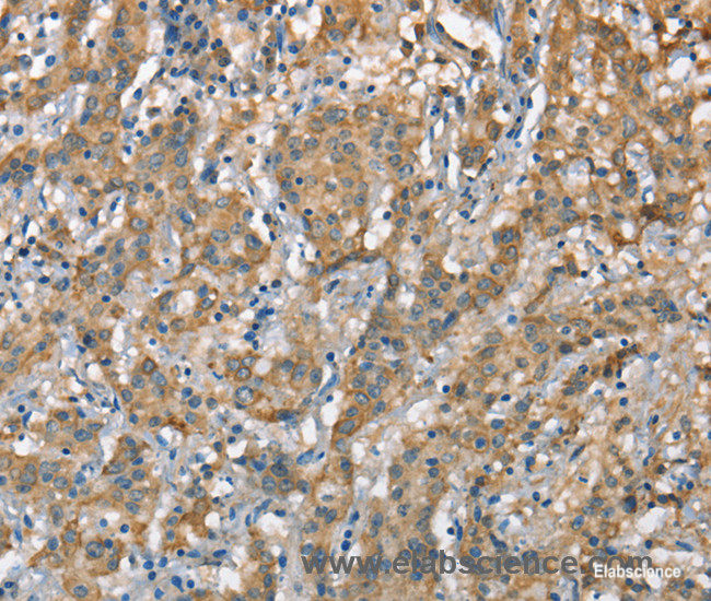 Immunohistochemistry of paraffin-embedded Human gasrtic cancer tissue using CSMD1 Polyclonal Antibody at dilution 1:40