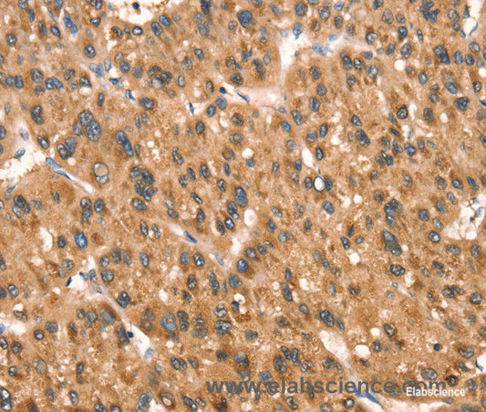 Immunohistochemistry of paraffin-embedded Human liver cancer tissue using DAP Polyclonal Antibody at dilution 1:40