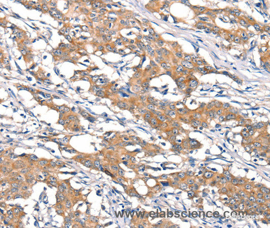 Immunohistochemistry of paraffin-embedded Human gasrtic cancer tissue using DSC1 Polyclonal Antibody at dilution 1:40