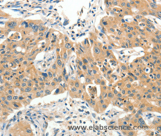 Immunohistochemistry of paraffin-embedded Human lung cancer tissue using SLC11A2 Polyclonal Antibody at dilution 1:65