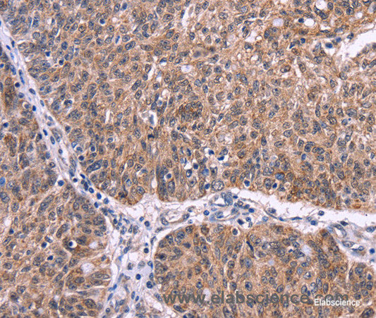 Immunohistochemistry of paraffin-embedded Human ovarian cancer tissue using Ephrin A5 Polyclonal Antibody at dilution 1:40