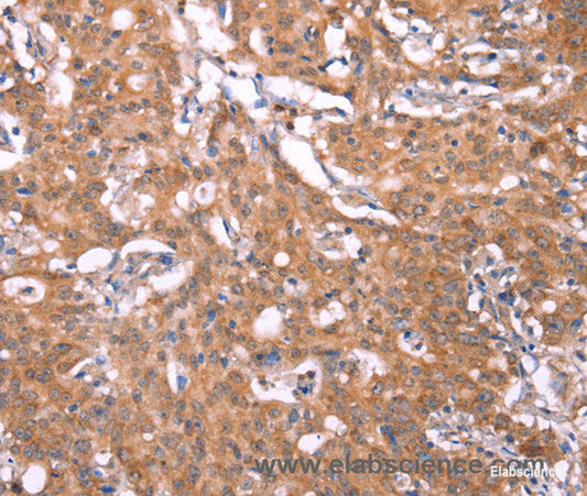 Immunohistochemistry of paraffin-embedded Human gasrtic cancer tissue using FBXO31 Polyclonal Antibody at dilution 1:40