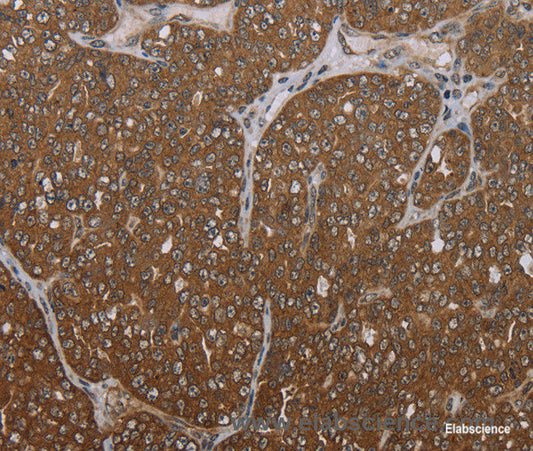 Immunohistochemistry of paraffin-embedded Human ovarian cancer tissue using FOLH1B Polyclonal Antibody at dilution 1:30