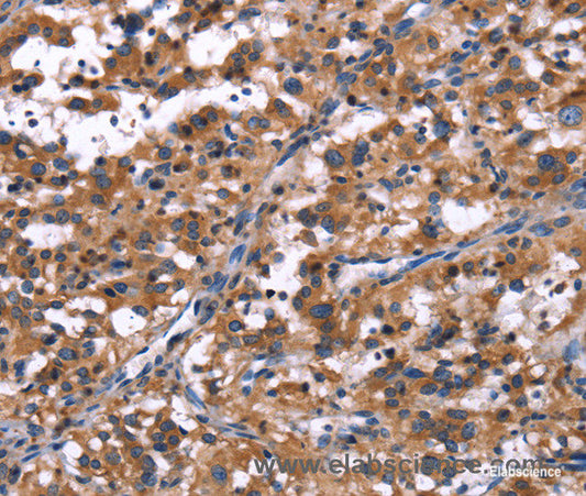 Immunohistochemistry of paraffin-embedded Human thyroid cancer tissue using R3HCC1L Polyclonal Antibody at dilution 1:40