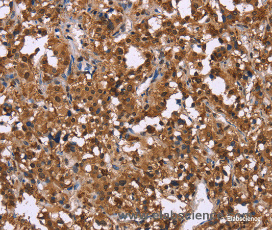 Immunohistochemistry of paraffin-embedded Human thyroid cancer tissue using GPR171 Polyclonal Antibody at dilution 1:40