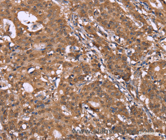 Immunohistochemistry of paraffin-embedded Human gasrtic cancer tissue using HLTF Polyclonal Antibody at dilution 1:40