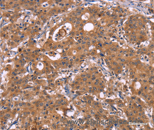 Immunohistochemistry of paraffin-embedded Human gasrtic cancer tissue using HMGCS1 Polyclonal Antibody at dilution 1:40