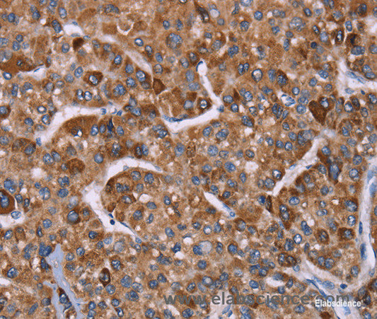 Immunohistochemistry of paraffin-embedded Human liver cancer tissue using HSP10 Polyclonal Antibody at dilution 1:40